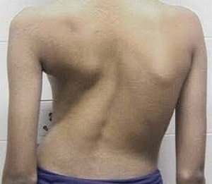 escoliosis como causa de dolor de espalda