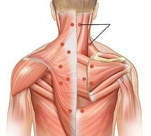 miositis como causa de dolor de espalda