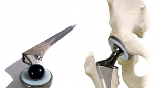 artroplastia de la articulación de la cadera para la artrosis