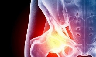 causas del desarrollo de la artrosis de cadera