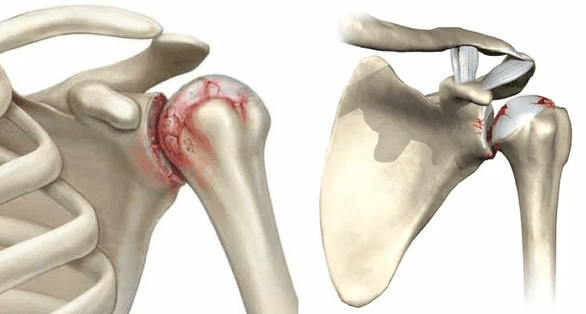 ¿Cómo se ve la artrosis de la articulación del hombro 