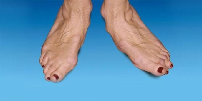 deformidad del pie con artrosis de tobillo
