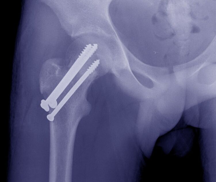 Radiografía de la articulación de la cadera, osteosíntesis de la fractura con dispositivos de fijación internos. 