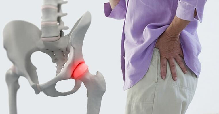 dolor en el área de la cadera, un síntoma de artrosis de la articulación de la cadera