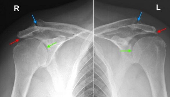 Radiografía de las articulaciones del hombro. 