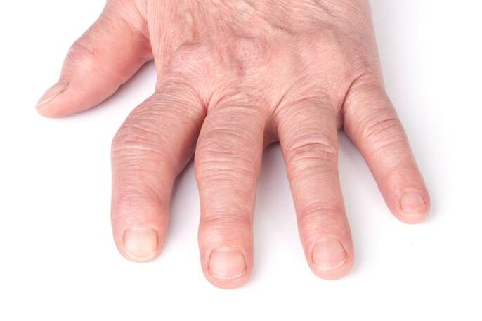 artrosis deformante en las manos