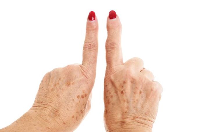 artrosis deformante en los dedos