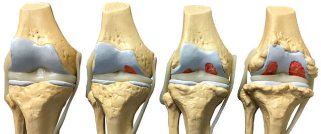 Daño articular en diferentes etapas del desarrollo de la artrosis de tobillo. 