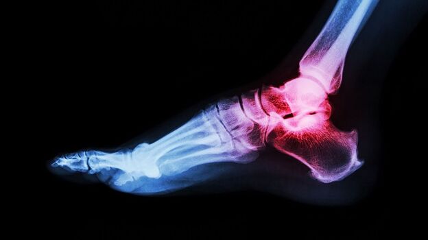 artrosis de tobillo