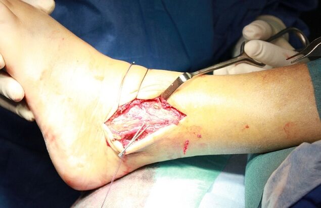 cirugía para la artrosis de tobillo