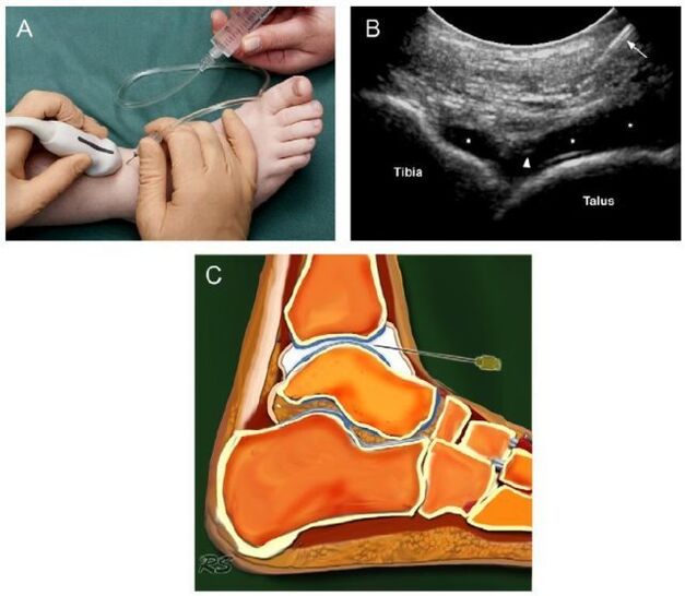 ecografía de la articulación del tobillo con artrosis