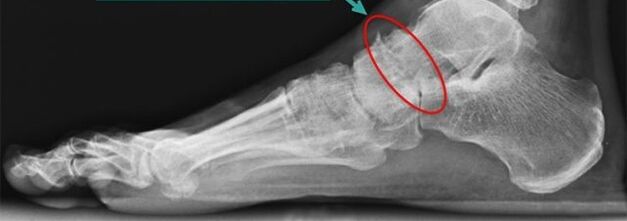 gammagrafía para la artrosis de tobillo