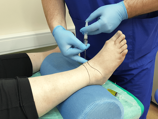 punción para la artrosis de la articulación del tobillo
