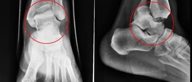 radiografía para artrosis de tobillo
