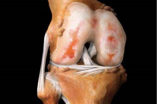 daño a la articulación de la rodilla con artrosis
