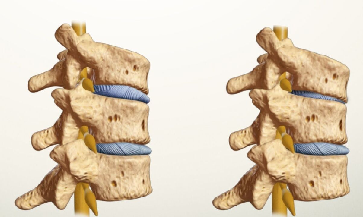 columna vertebral sana y enferma con osteocondrosis lumbar