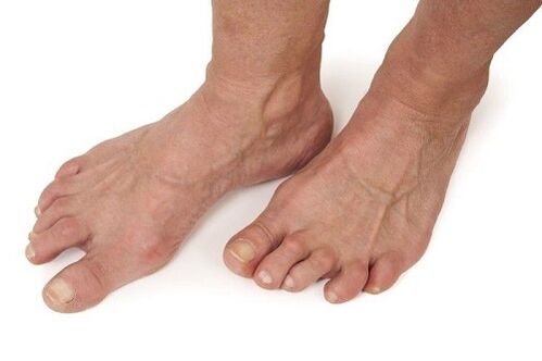 pies afectados por artrosis