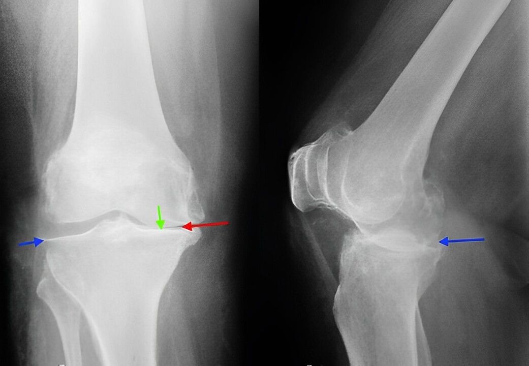 Radiografía de artrosis de la articulación de la rodilla. 