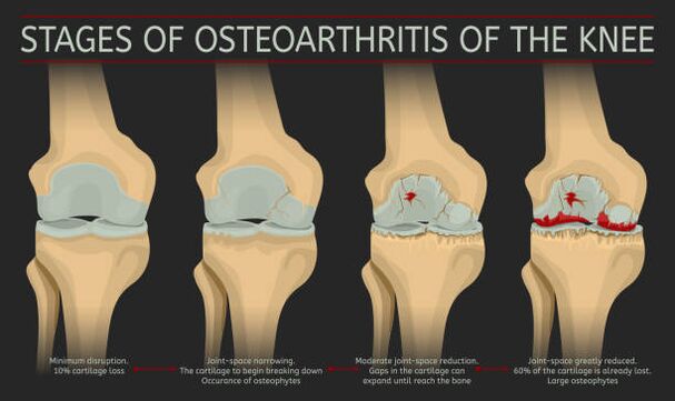 desarrollo de artrosis articular