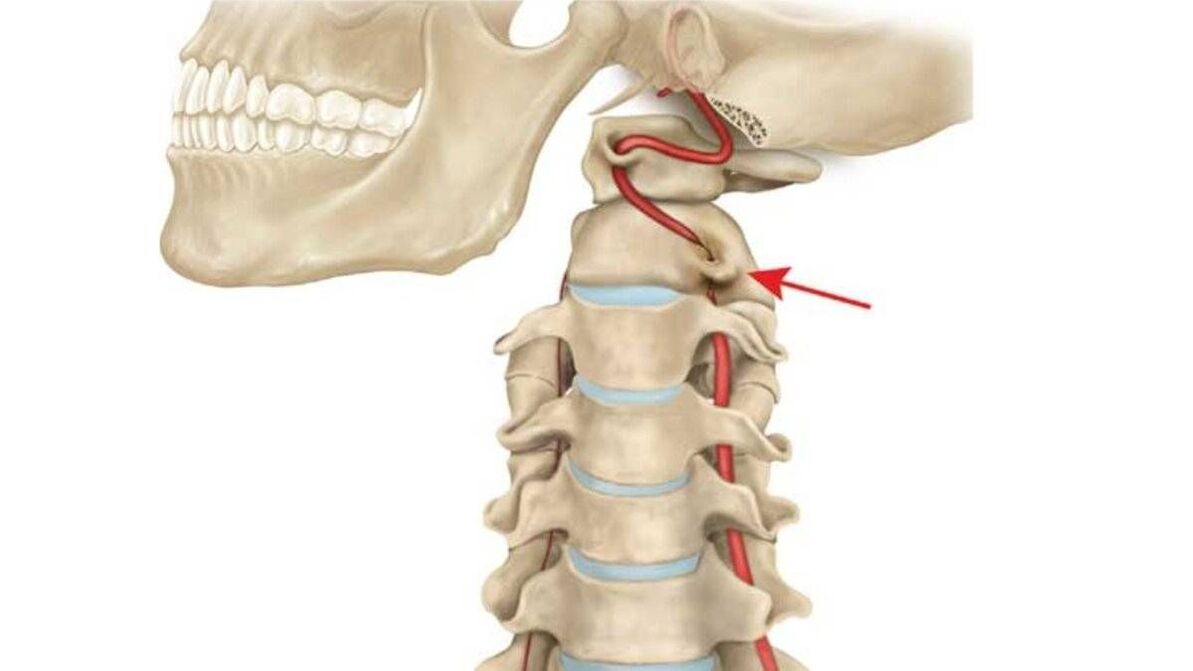 osteocondrosis de la columna cervical