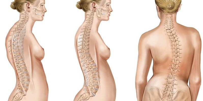 La escoliosis de la columna torácica provoca dolor en los omóplatos.
