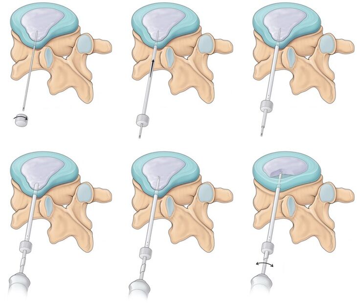 cirugia para el dolor de espalda