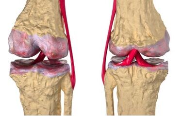 Las venas varicosas son la causa del desarrollo de gonartrosis.